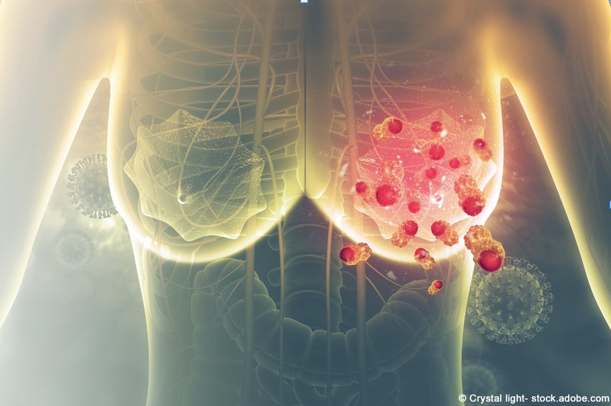 Maria Hafez, MD, spotlights updated outcomes with T-DM1 in patients with residual invasive HER2-positive breast cancer after neoadjuvant treatment and surgery, and more. <a href="/KimmelCancerCtr/">Sidney Kimmel Comprehensive Cancer Center</a> #bcsm onclive.com/view/explorato…