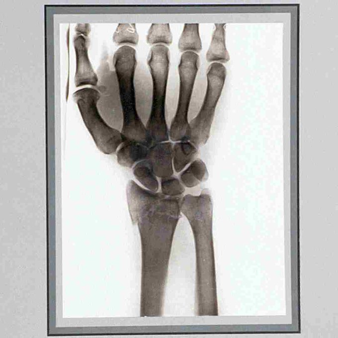 15407 X-Ray Photograph of a Human Hand with Wrist Injury, by H. J. Hickman, c.1916