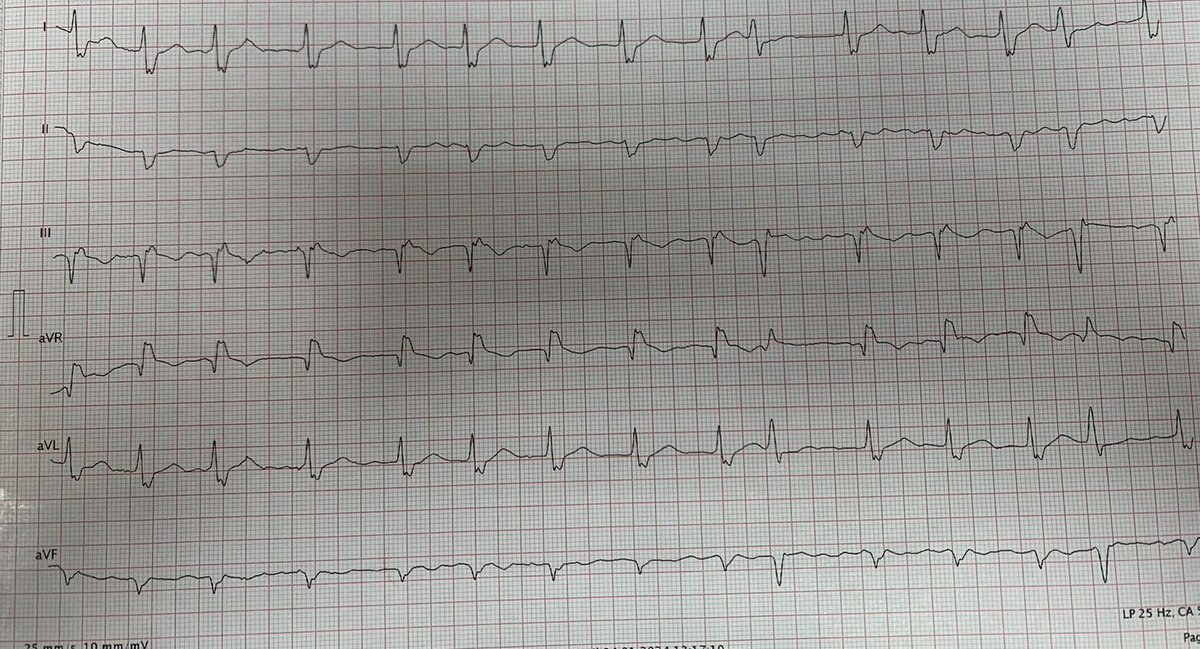 atypicalflutter's tweet image. 🚨 #CaseStudy: 88-year-old obese patient, no previous CVD history, presents to ER with palpitations &amp;amp; dyspnea. Echo EF 50%, no segmental wall motion abnormalities. Exhibits wide QRS tachycardia, treated with DC shock. Diagnosis? @narrowQRS @ecgrhythms @ECGTalk @smithECGBlog