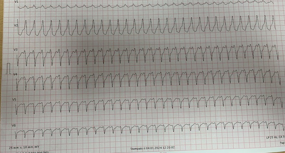 atypicalflutter's tweet image. 🚨 #CaseStudy: 88-year-old obese patient, no previous CVD history, presents to ER with palpitations &amp;amp; dyspnea. Echo EF 50%, no segmental wall motion abnormalities. Exhibits wide QRS tachycardia, treated with DC shock. Diagnosis? @narrowQRS @ecgrhythms @ECGTalk @smithECGBlog