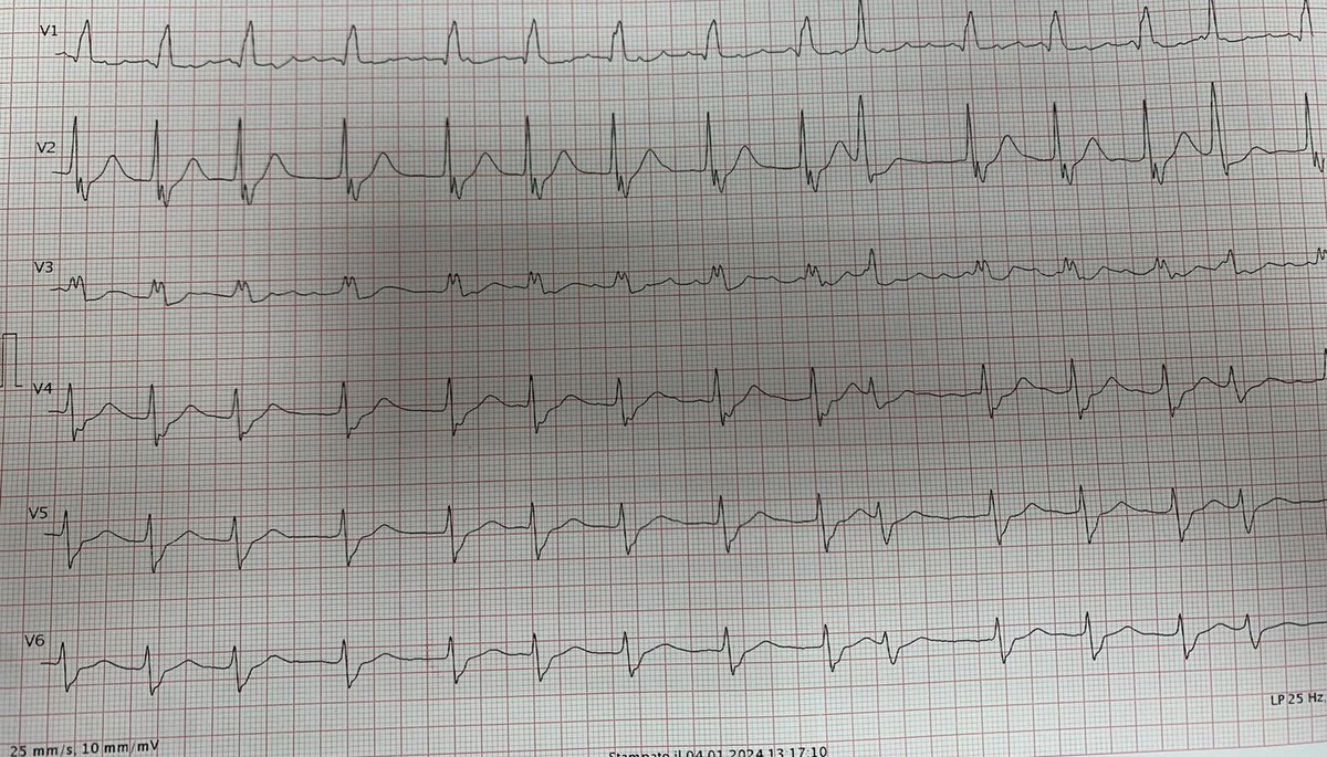 atypicalflutter's tweet image. 🚨 #CaseStudy: 88-year-old obese patient, no previous CVD history, presents to ER with palpitations &amp;amp; dyspnea. Echo EF 50%, no segmental wall motion abnormalities. Exhibits wide QRS tachycardia, treated with DC shock. Diagnosis? @narrowQRS @ecgrhythms @ECGTalk @smithECGBlog