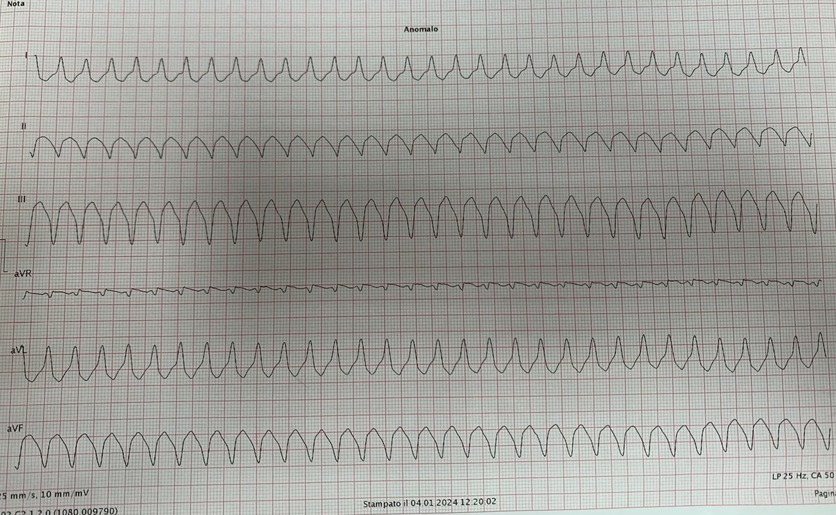 atypicalflutter's tweet image. 🚨 #CaseStudy: 88-year-old obese patient, no previous CVD history, presents to ER with palpitations &amp;amp; dyspnea. Echo EF 50%, no segmental wall motion abnormalities. Exhibits wide QRS tachycardia, treated with DC shock. Diagnosis? @narrowQRS @ecgrhythms @ECGTalk @smithECGBlog