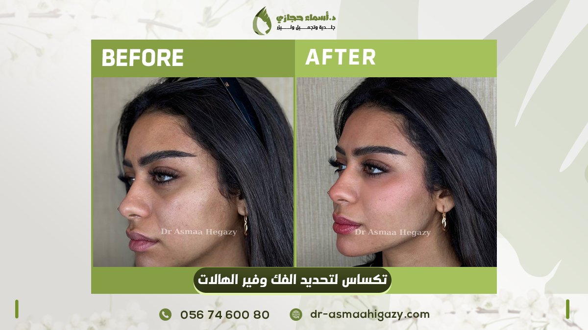 asmaahigazy2004's tweet image. الفيلر لمسة من الجمال ليزداد جمالك 😍

فيلر تكساس لإبراز الفك مع فيلر تحت العين لاخفاء التجويف وتحسين لون الاسمرار حول العين 🫰🏻

مع ملكة الفيلر..جمالك هيزيد 🤝🏻

للحجز والاستفسار 📲
 جدة السعودية
0567460080
مصر
01050279993

#دكتور_اسماء_حجازي
#جمالك_طبيعي_مع_دكتور_اسماء_حجازي