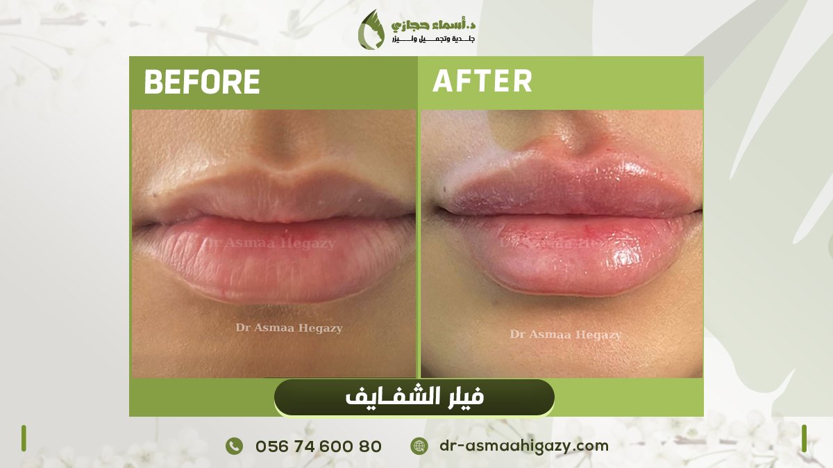 asmaahigazy2004's tweet image. فيلر شفايف 💉 مع ملكة الفيلر دكتورة أسماء حجازي 👩🏼‍⚕️❤️

زيدي شفايفك جمال وأنوثة مع الفيلر ❤️‍🔥

جمالك هدفنا.... وجمالك بيزيد مع دكتورة أسماء حجازي 👩🏼‍⚕️❤️

للحجز والاستفسار 📲

فرع جدة السعودية
0567460080
فرع مصر
01050279993

#دكتور_اسماء_حجازي
#جمالك_طبيعي_مع_دكتور_اسماء_حجازي