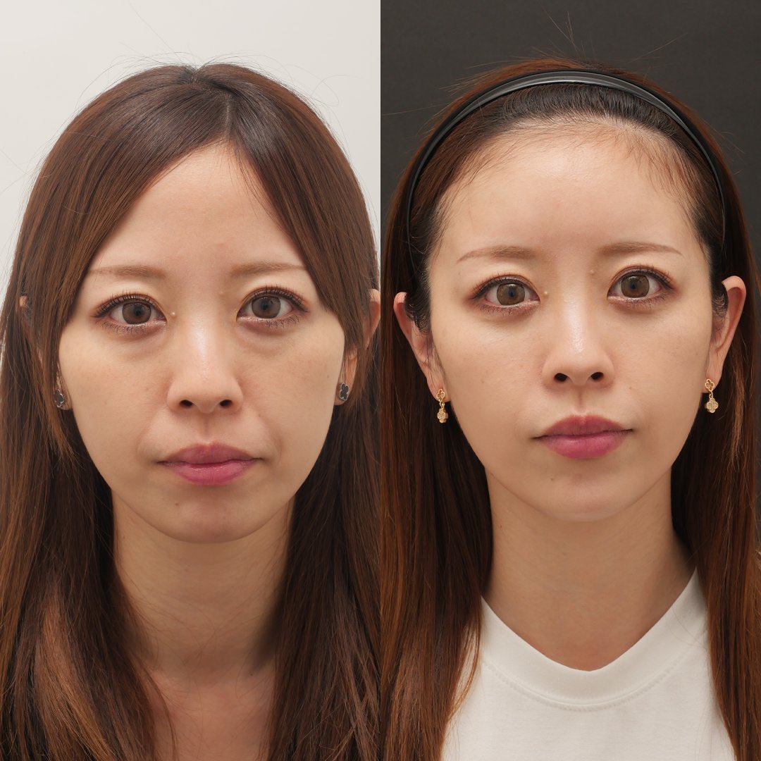 picopucopaco's tweet image. 大山先生のこの症例凄い...
ボトとヒアルを顔の影を消すように入れてくれるらしく
糸リフトとかハイフの比にならんくらい若返ってる。
特に中顔面陥没が一気に改善されて童顔になっててうらやま🥲てかヒアルだけでこんな人中短くできるんだ...
横顔から見ても超綺麗で口ゴボも治せるっぽい。カウセいく