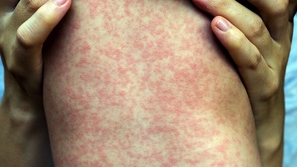 DailyMail's tweet photo. Measles outbreak in Pennsylvania's top children's hospital has health officials concerned- as more kids than ever are unvaccinated against the deadly disease https://t.co/kA90KaReMn https://t.co/HfsBn1TC7K