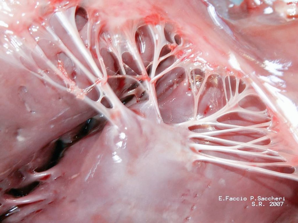 💔| LA MUERTE POR CORAZÓN ROTO ES POSIBLE 

Quizás lo escuchaste muchas veces metafóricamente, pero en realidad morir de "Corazón roto" sí es posible ya que los cordones tendinosos del corazón pueden llegan a romperse bajo mucha tristeza. 

El síndrome del corazón roto es una