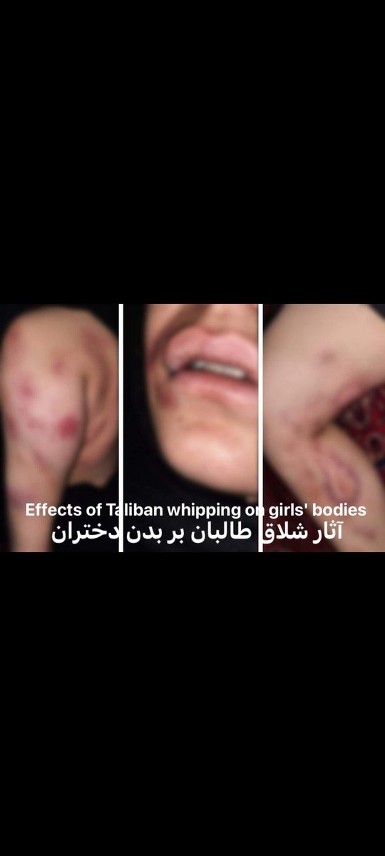 SimaNoori1's tweet photo. Where are the effects of whipping on the bodies of the girls and women tortured by the Taliban in Afghanistan - where are the human rights?! Where are the voices of the statesmen who interact with the Taliban? don’t they see?
#زنان_حذف_شدني_نيستند 
@SR_Afghanistan @hrwafghanistan @hrw @UNOCHA @antonioguterres @AminaJMohammed @SE_AfghanWGH @US4AfghanPeace @