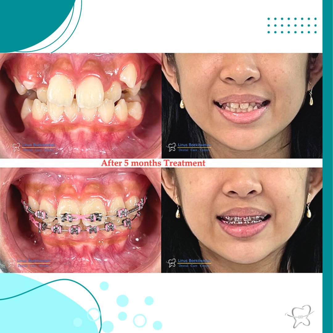DrgLinus's tweet photo. Have patience. All things are difficult before they become easy...

New SMILE... New Life...

#drglinus #braces #invisalign #behelgigi #beheltransparan https://t.co/v142IJYTyT
