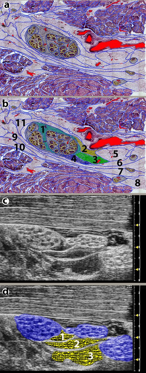 bjanaesthesia.org/article/S0007-… Prof Reina and I summarise our histology and microultrasound research that lays the basis for a change in practice <a href="/NIAAResearch/">NIAA Research</a> <a href="/BJAJournals/">British Journal of Anaesthesia</a> <a href="/ESRA_Society/">ESRA | European Society of Regional Anaesthesia</a> <a href="/RegionalAnaesUK/">RA-UK</a>