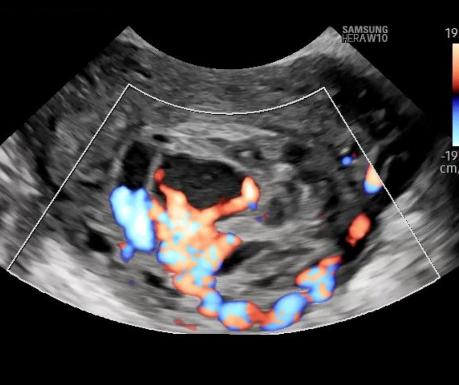Doppler ultrasound of interstitial ectopic pregnancy. There is... |  Download Scientific Diagram