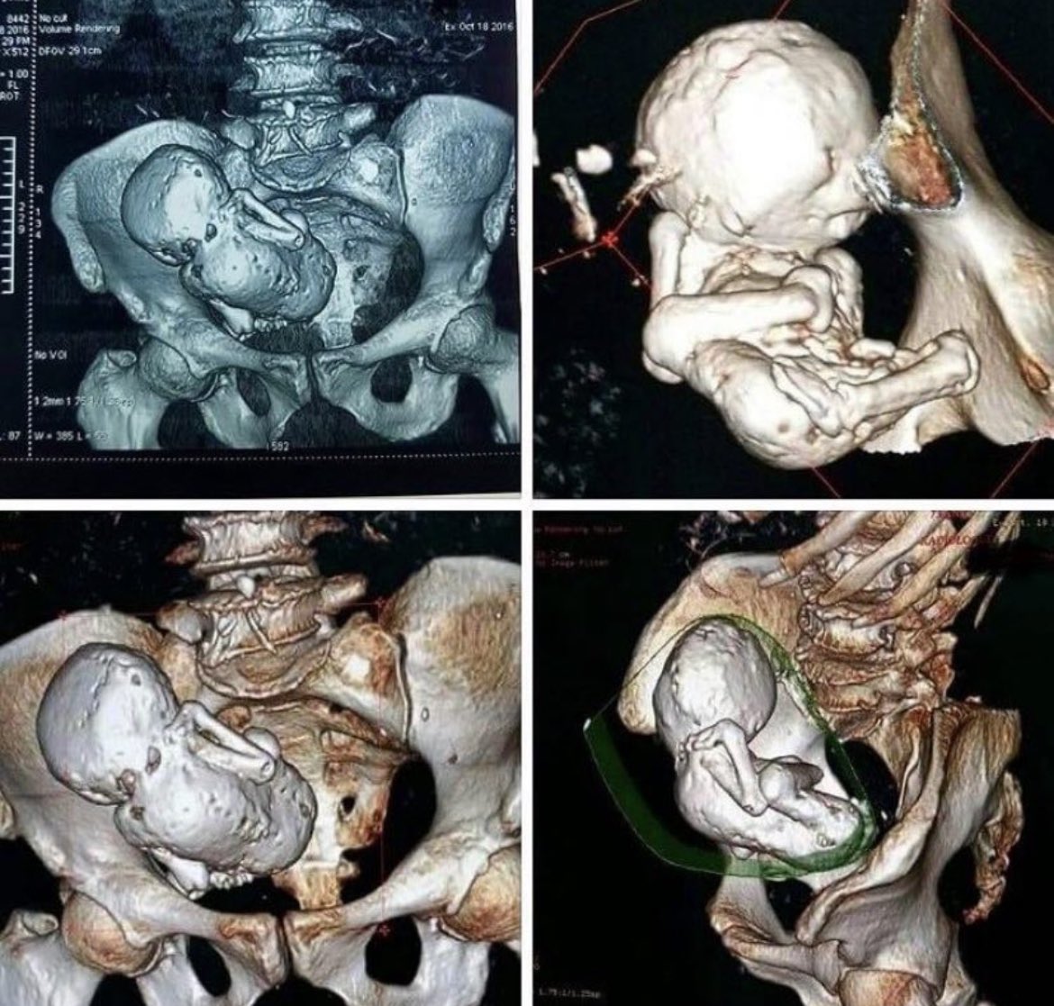 CT scan shows the moment doctors found a ‘stone baby’ inside the womb of a 73-year-old woman from Algeria. The stone baby, also known as a lithopedion is created when a pregnancy forms in the abdomen rather than in the uterus. 

When the pregnancy fails, the body lacks a…