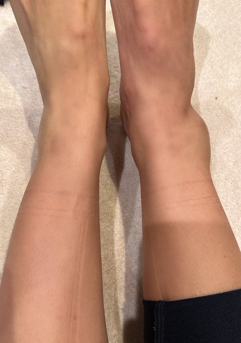 May have fractured my ankle idk what do u guys think kek https://t.co/zULJTmrbK5