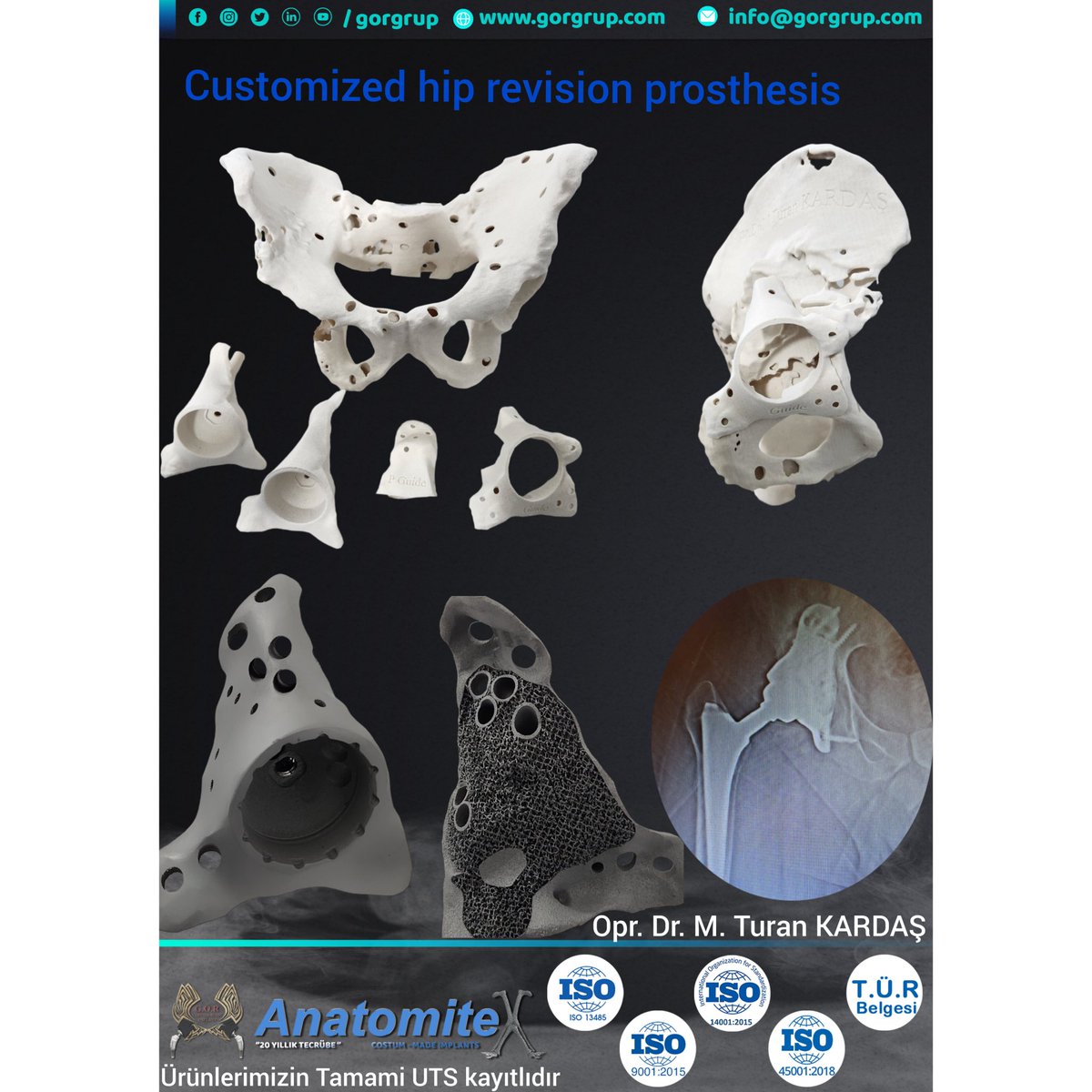 Opr. Dr. M. Turan KARDAŞ hocamızın kişiye özel trabekuler kaplı revizyon kalça protezi #ortopedi #custommadeprotez #trabekuler  #bioprinting #orthopedics #orthopedicsurgery #orthopedicsurgeon  #ortopedikcerrahi #kalçaprotezi