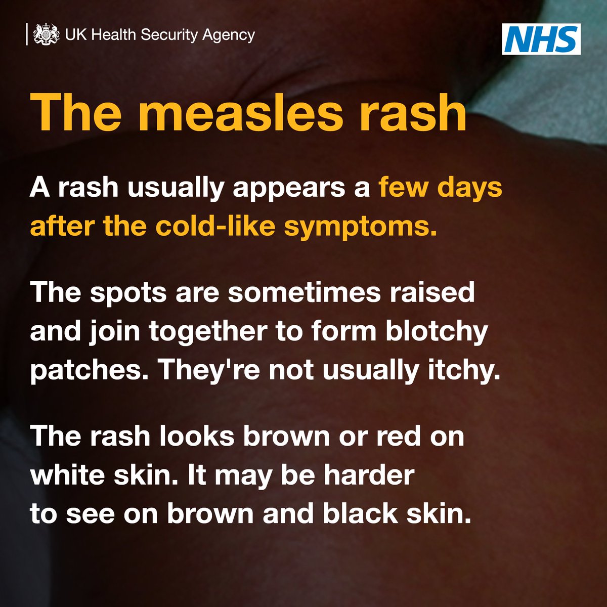 OFFICIALWMAS's tweet photo. Measles is on the rise in the UK.

Vaccination💉 is the best way to protect you and your family from a potentially deadly virus. https://t.co/EIRsU2vEqL