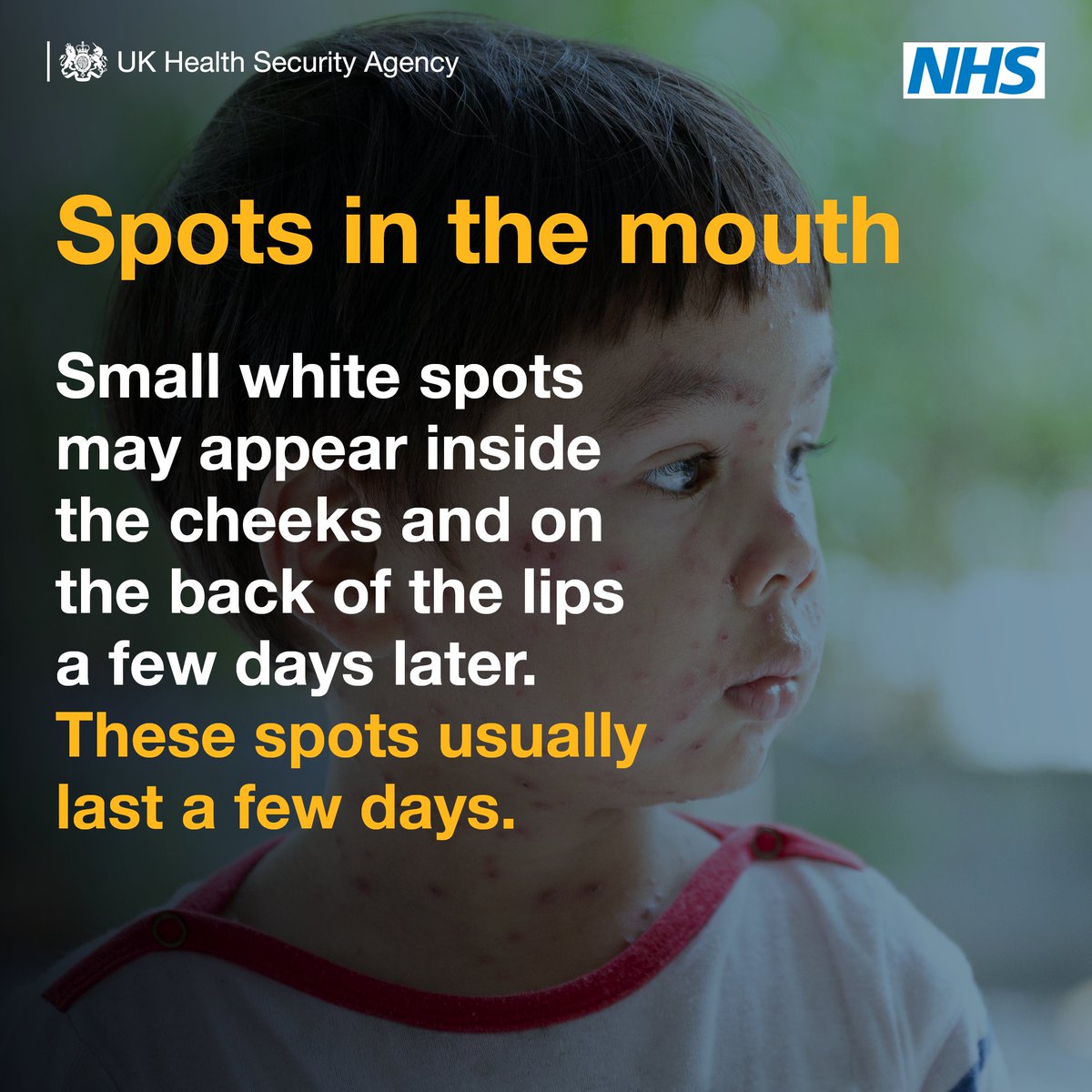 OFFICIALWMAS's tweet photo. Measles is on the rise in the UK.

Vaccination💉 is the best way to protect you and your family from a potentially deadly virus. https://t.co/EIRsU2vEqL
