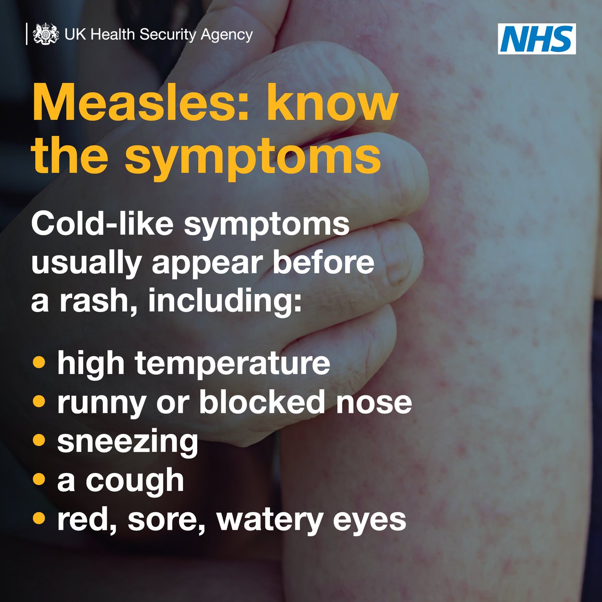 OFFICIALWMAS's tweet photo. Measles is on the rise in the UK.

Vaccination💉 is the best way to protect you and your family from a potentially deadly virus. https://t.co/EIRsU2vEqL