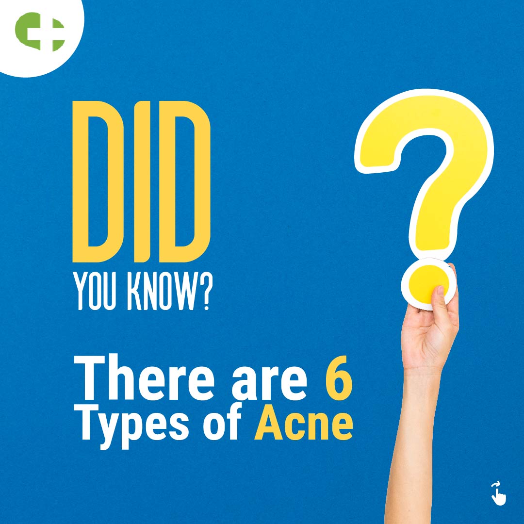 NetMeds's tweet photo. Spot the Difference: Whiteheads, blackheads, and those occasional pimple rebels! 🕵️♀️✨ Understanding the diverse world of acne to curate your personalized skincare routine
#acneproblem #skincare #netmeds https://t.co/acb6jmOxhG