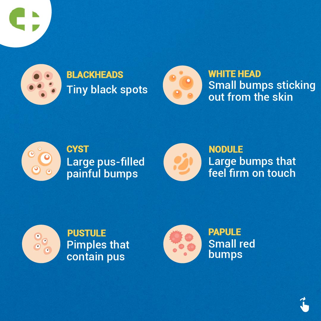 NetMeds's tweet photo. Spot the Difference: Whiteheads, blackheads, and those occasional pimple rebels! 🕵️♀️✨ Understanding the diverse world of acne to curate your personalized skincare routine
#acneproblem #skincare #netmeds https://t.co/acb6jmOxhG