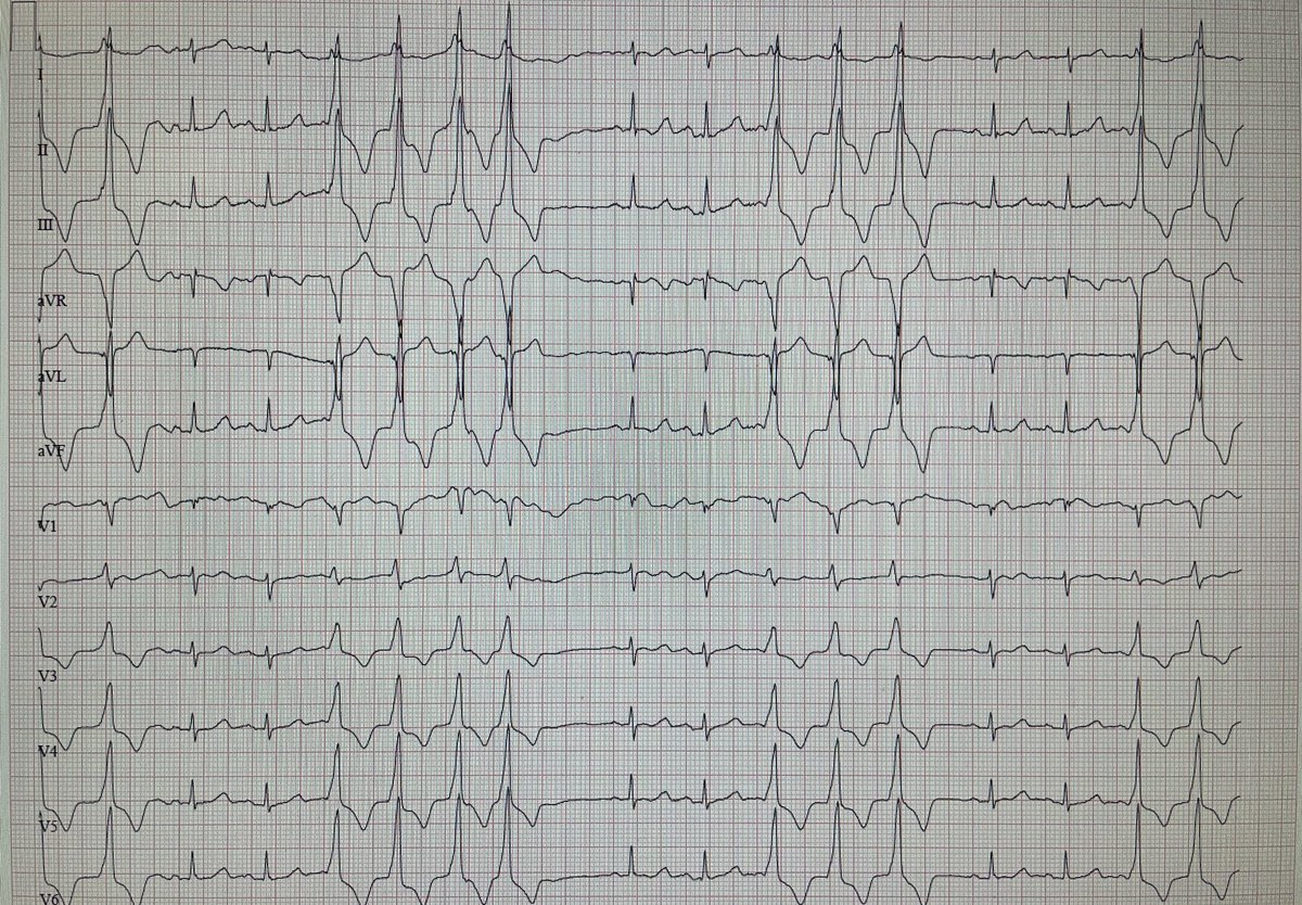 Elder Male admitted for UTI. No reported Hx CAD or HF. No symptoms, but starts doing this. #ECG #CardioTwitter #MedTwitter