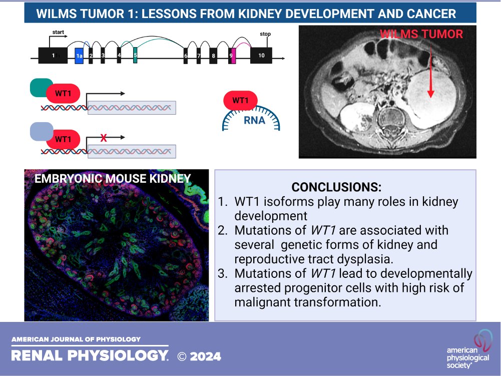 AJPRenal's tweet image. #AJPRenal 
🆕 Review 
#Wilms’ tumor gene 1: lessons from the interface between #KidneyDevelopment and #cancer
By: Elena Torban and Paul Goodyer
🖱️ow.ly/W6Wx50Qo8jx
@Human_Genetics