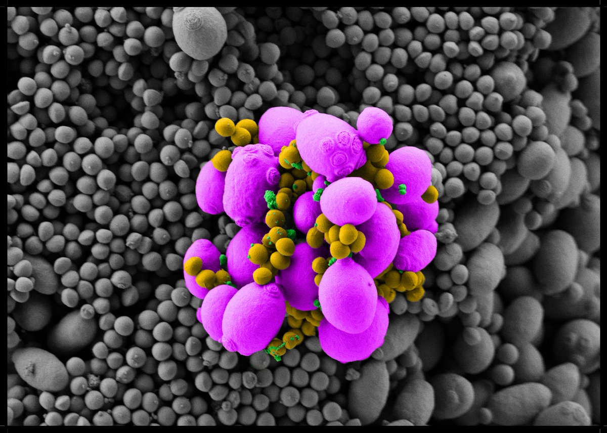 MRC Centre for Medical Mycology (@mrccmm) on Twitter photo Discover our 'Hidden World of Killer Fungi' exhibition, opening tomorrow in <a href="/UniofExeter/">University of Exeter</a> Queens Building!
Explore striking images like this one of Candida glabrata & Staphylococcus aureus by <a href="/orlandorosss/">Orlando</a> & <a href="/SeanaDuggan/">Seána Duggan</a>
tinyurl.com/5n8unex4 <a href="/artsandculturex/">Arts and Culture University of Exeter</a> @exetermed Discover our 'Hidden World of Killer Fungi' exhibition, opening tomorrow in <a href="/UniofExeter/">University of Exeter</a> Queens Building!
Explore striking images like this one of Candida glabrata & Staphylococcus aureus by <a href="/orlandorosss/">Orlando</a> & <a href="/SeanaDuggan/">Seána Duggan</a>
tinyurl.com/5n8unex4 <a href="/artsandculturex/">Arts and Culture University of Exeter</a> @exetermed