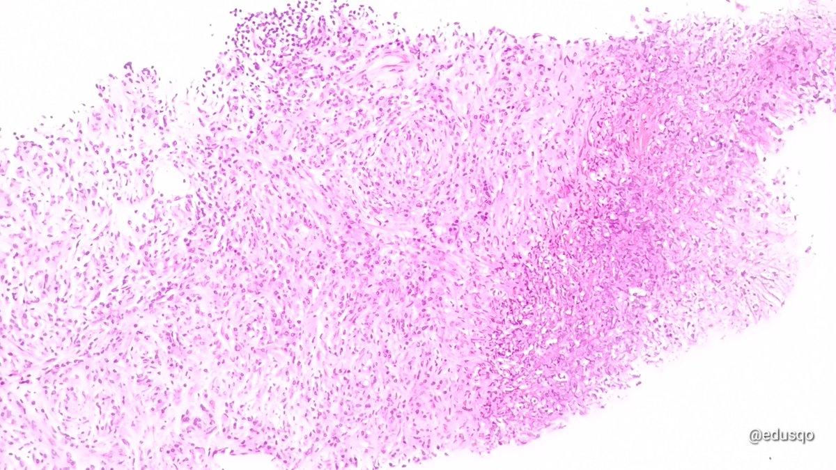 Pulmonary rheumatoid nodules are a rare manifestation of rheumatoid arthritis:
▫️<0.4% Rx studies.
▫️32% lung biopsies with RA + nodules.
▫️Granulomatous reaction with central necrosis histiocytes, lymphocytes, plasma cells and fibroblasts.
▫️DDx: infection/malignancy.
#PulmPath