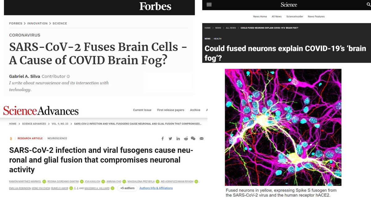 DaniBeckman's tweet photo. For this #FluorescenceFriday, I want to share the first photo I took of microglia cells fusing each other. I have never seen this before; who did this? #HIV. 

I have looked at brains under the microscope for many years now, but knowing that neurons and glial cells can fuse with each other is something I never learned during my Ph.D. We learn that most viruses don't even directly cause damage to the brain, and when they do, it is only because they killed their host cells. However, some chronic neurological sequelae of viral infections cannot be explained only by neural cell death. 

It is known that in non-neuronal tissues, viruses fuse with host membranes to enter cells, hijacking the cellular machinery to produce viral components and sometimes conferring the ability to fuse with neighboring cells. This results in the formation of multinucleated cells, allowing viral propagation without needing virion release into the extracellular space.

Guess what? Viral-mediated fusion of brain cells also exists but still remains poorly understood. 
The irreversible fusion of brain cells causes disruption in neuronal communication and reveals another possible mechanism to explain chronic neuronal malfunction even many years after the initial infection.

We now know that  #SARSCoV2 can also cause brain cells to fuse, especially inducing neuron-neuron fusion. Instead of firing independently to propagate signals throughout the brain, fused neurons fire simultaneously, and this massive amount of synchronous activity is similar to seizure-like events. The desynchronized neuronal activity caused by fused neurons can also help explain symptoms like brain fog. When these events occur in the autonomic nervous system, for example, it can help explain dysautonomia, which so often happens with #LongCovid patients.

We must keep fighting against the concept that the brain is an isolated, immuno-privileged site. 
Immune privilege, a term coined by the Nobel Prize winner Peter Medawar in the 1940s, holds that a few sites in the body, including the brain, do not show typical inflammatory responses, an evolutionary adaptation to protect these critical sites from potentially damaging inflammation. This could not be more far from the truth. Unfortunately, evolution did not give us this unique ability. This dogma has only served to bias the interpretation of our findings and slow the discovery of basic mechanisms induced by the presence of pathogens and potential therapies to counteract them.