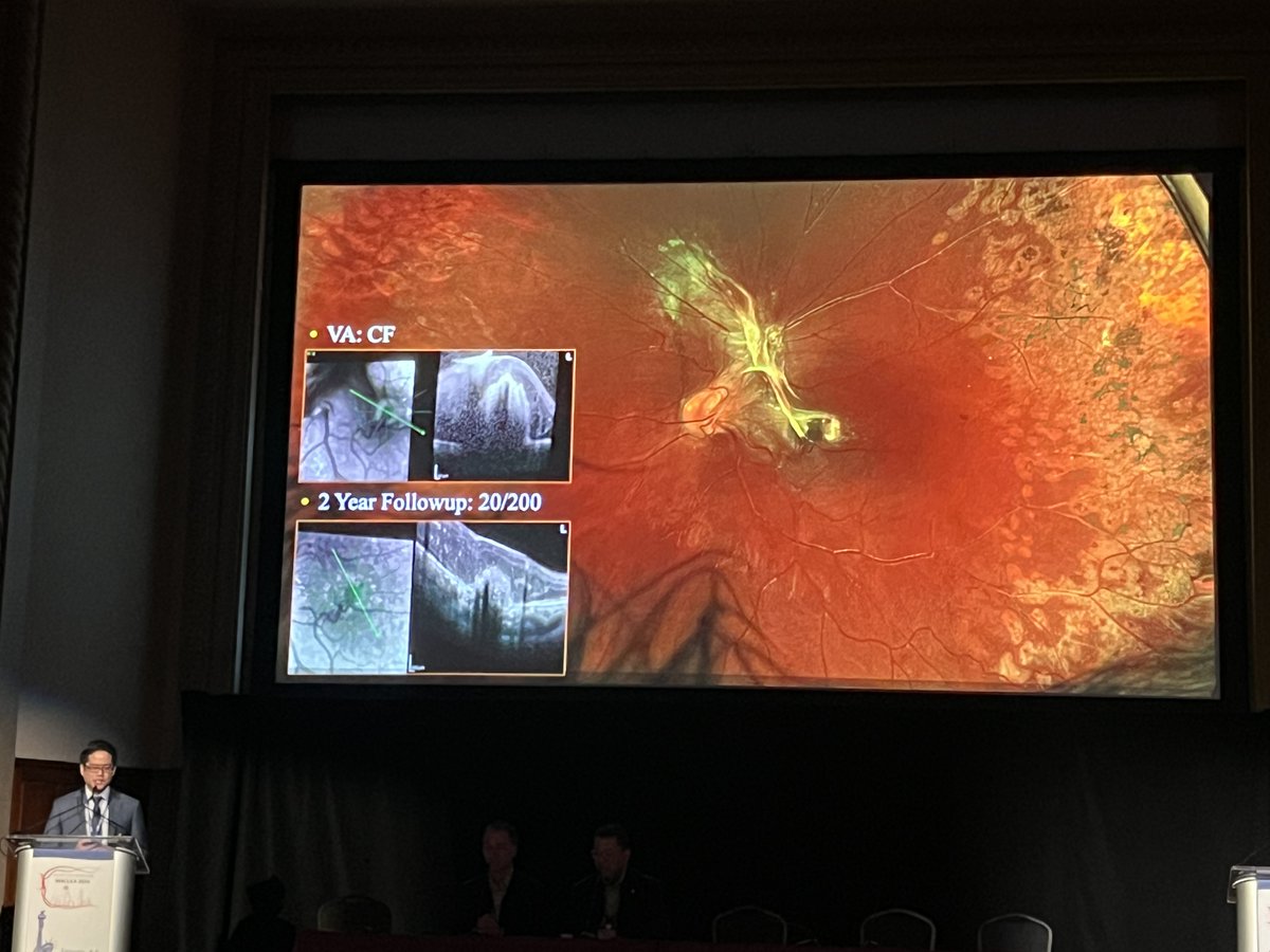 @YoshiYonekawaMD presented two cases of tractional RD in the setting of Coats disease. Traction is rare in these paitents, so let Dr. Yonekawa know if you have a case of your own! #ACRC2024 #Retina