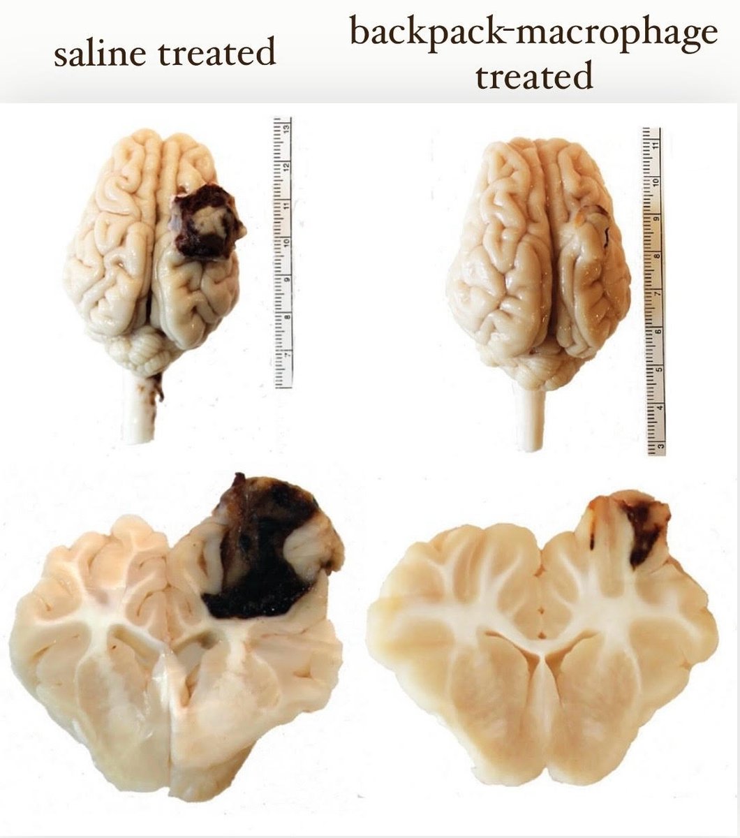 Neha Kapate, PhD (@nehakapate) on Twitter photo Excited to share the 2nd part of my thesis! We demonstrate that macrophages attached with anti-inflammatory particles ("backpacks") infiltrate into the brain after traumatic brain injury and reduce lesion volume by 56%. shorturl.at/oqH02 <a href="/SMitragotri/">Samir Mitragotri</a> <a href="/hseas/">Harvard SEAS</a> <a href="/wyssinstitute/">Wyss Institute</a> Excited to share the 2nd part of my thesis! We demonstrate that macrophages attached with anti-inflammatory particles ("backpacks") infiltrate into the brain after traumatic brain injury and reduce lesion volume by 56%. shorturl.at/oqH02 <a href="/SMitragotri/">Samir Mitragotri</a> <a href="/hseas/">Harvard SEAS</a> <a href="/wyssinstitute/">Wyss Institute</a>
