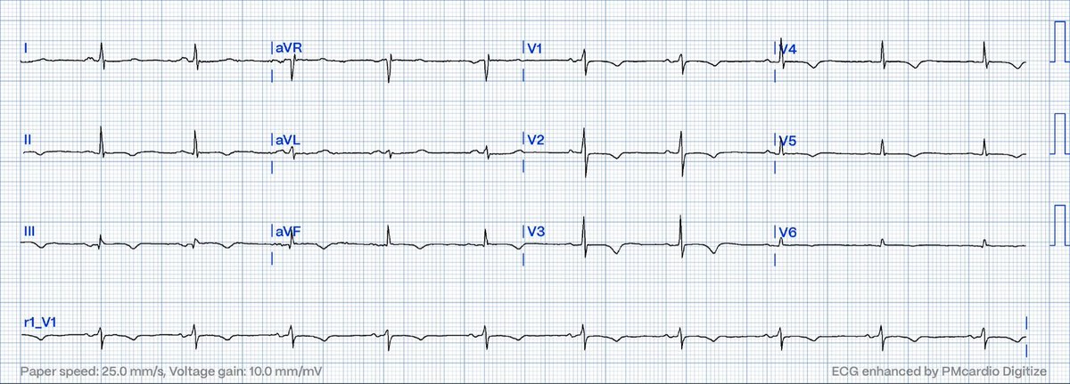 59F with CAD. Presents with chest burning into throat and L arm. “Feels like my last heart attack.” Symptoms improving but not resolved on nitro. Two ECGs shown.