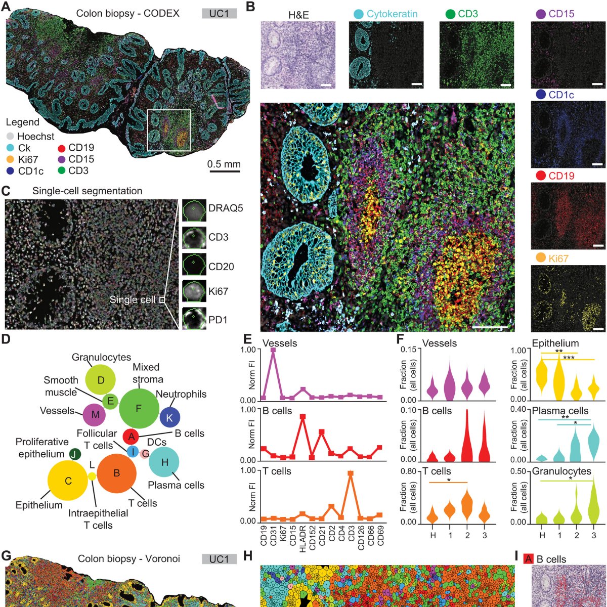AkoyaBio's tweet photo. A great study by Dr. Aaron Mayer @EnableMedicine et al., establishes #spatialphenotyping using #PhenoCycler to gain valuable insights into the mechanisms behind the progression of #UlcerativeColitis and its response to therapy. https://t.co/Hy5WoBayGc @ScienceAdvances #FridayRead https://t.co/f7BmGAGKWl