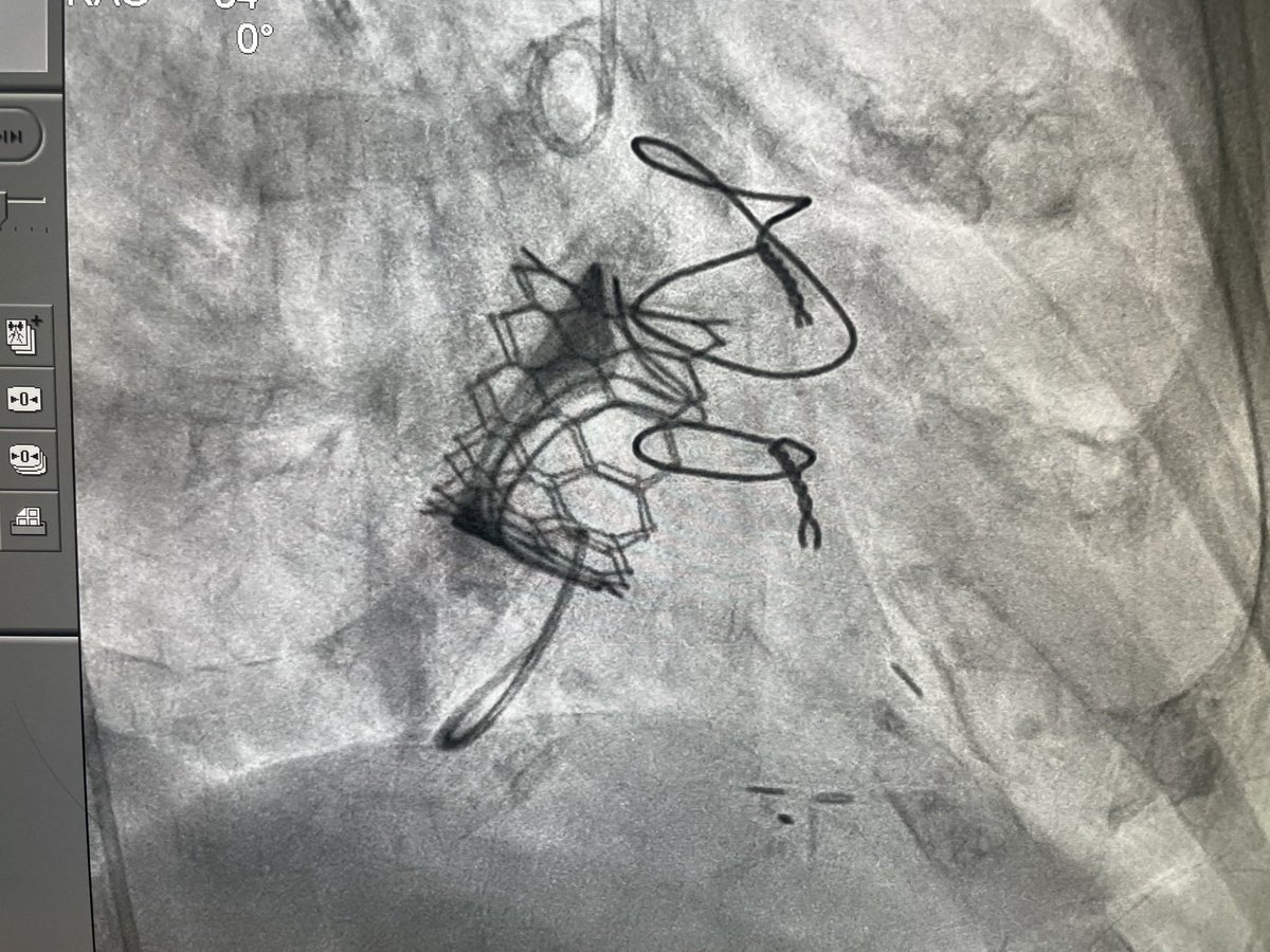 #TAVI and #TMVR. At #Lilavati Hospital. Shared our best practices of doing safe TAVI with visiting cardiologist and shows them to live cases.
Our experience helps us to deliver safe outcomes in TAVI and TMVR.
#TAVI #TAVR #AorticStenosis #lilavati #Mumbai