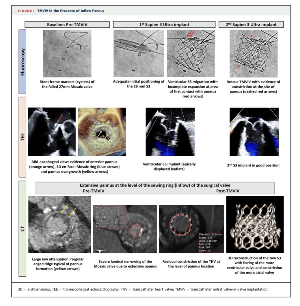 Ali S. Husain د.علي صاحب حسين (@alisahebhusain) on Twitter photo Take a peek at our first publication of the new year!
❗️ Pannus can pose challenges for TMViV procedures.
❗️“watermelon seeding” phenomenon.
❗️ In our case, THV migrated ventricularly.
❗️ Another THV deployed to prevent embolization.
jacc.org/doi/10.1016/j.…
<a href="/JACCJournals/">JACC Journals</a> Take a peek at our first publication of the new year!
❗️ Pannus can pose challenges for TMViV procedures.
❗️“watermelon seeding” phenomenon.
❗️ In our case, THV migrated ventricularly.
❗️ Another THV deployed to prevent embolization.
jacc.org/doi/10.1016/j.…
<a href="/JACCJournals/">JACC Journals</a>