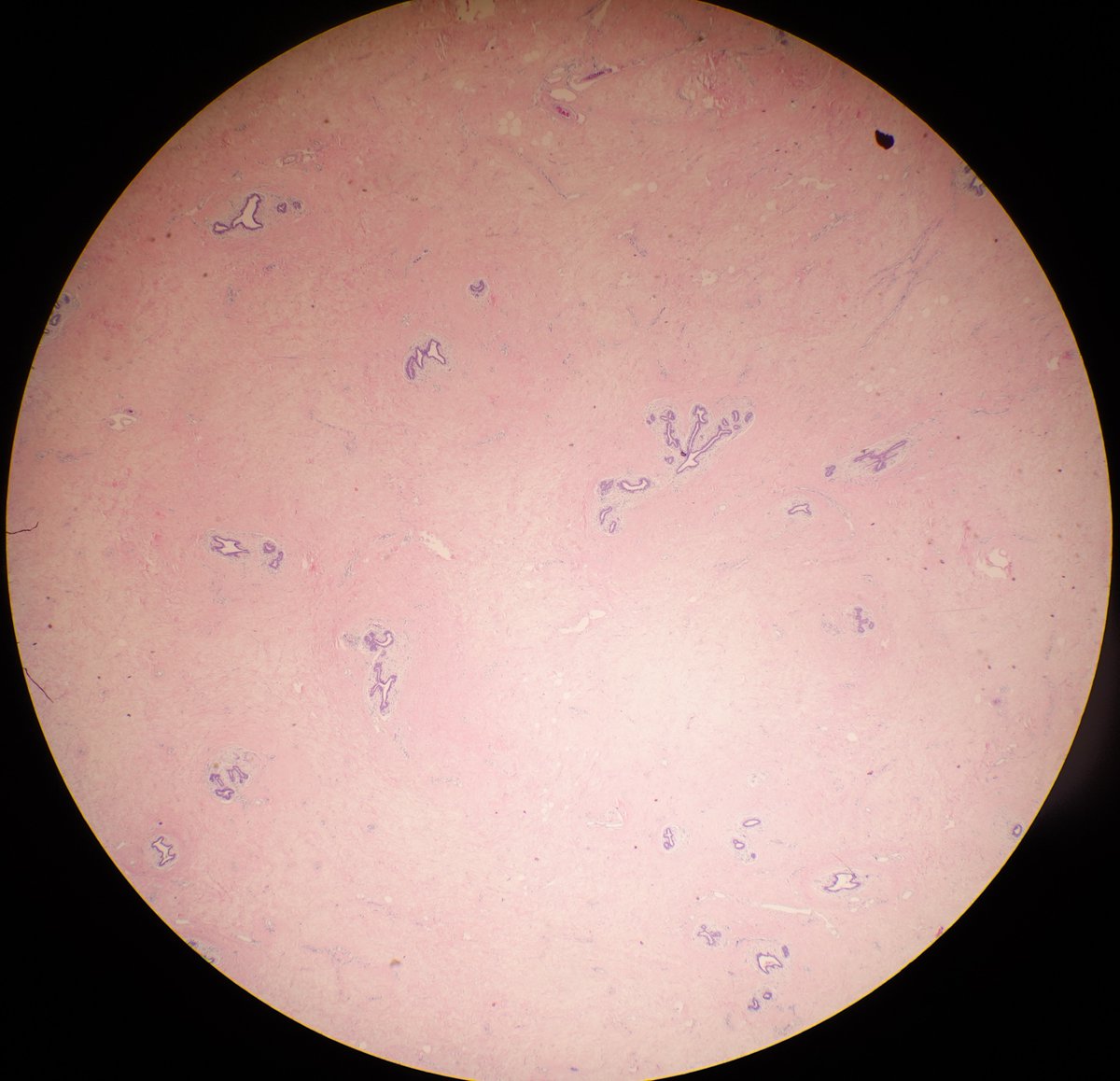 RFutoran's tweet photo. This is a good case to test your recognition of breast tissue.  What's going on here.  Why did it get excised?  Hint: It was not what I initially thought.  #PathTwitter #Brstpath #BeautyInTheBenign https://t.co/ukPcQdKO2H