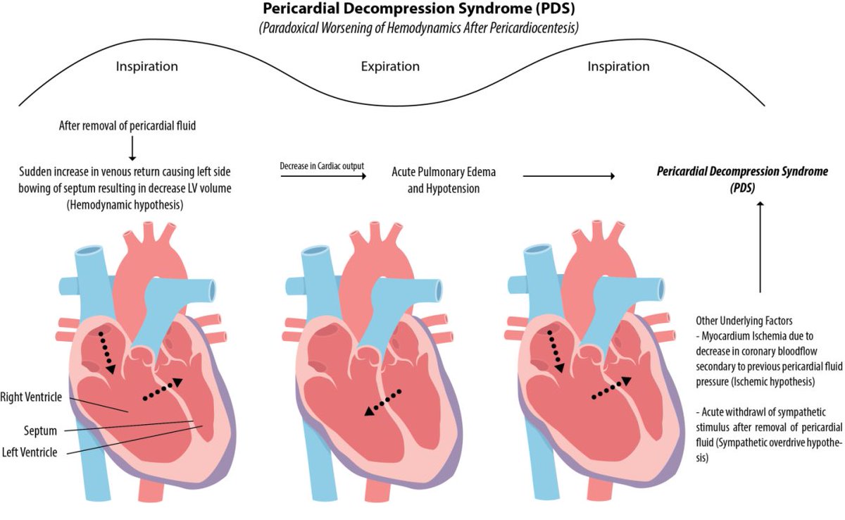 EmergPOCUS's tweet photo. 🚨💔Síndrome de Descompresión Pericárdica (SDP) 💔🚨
                     
                   👇🏼🧵💔🧶👇🏼(hilo)

🫶🏽¿Qué es el SDP?

  - 🌪️ Es el empeoramiento paradójico de la hemodinámica y desarrollo de edema pulmonar tras drenaje pericárdico sin complicaciones.
  - 🫀 Afecta a pacientes con derrames pericárdicos (a menudo grandes) o fisiología de taponamiento cardíaco.
  - 💔 También conocido como síndrome de bajo gasto cardíaco post-drenaje pericárdico.

- 🧐 Patofisiología del SDP:
  - ❓ No completamente entendida.
  - ❤️ Fuerte asociación con disfunción ventricular subyacente.
  - 📈 Tres mecanismos plausibles.
  - 1️⃣ Primera hipótesis: Trastorno hemodinámico paradójico.

  - 🔄 Después de retirar el l��quido pericárdico, hay un aumento repentino en el retorno venoso que provoca el abombamiento del septo hacia el lado izquierdo, lo que resulta en la disminución del volumen del ventrículo izquierdo (#Hipótesis hemodinámica).

- 💧 Secuencia de eventos:
  - 🫀 Tras la eliminación del líquido pericárdico.
  - ➡️ Disminución del gasto cardíaco.
  - 🌊 Edema pulmonar agudo e hipotensión.

  - 💢 Isquemia del miocardio por disminución del flujo sanguíneo coronario secundario a la presión del líquido pericárdico anterior (#Hipótesis isquémica).
  - 📉 Retirada aguda del estímulo simpático tras la eliminación del líquido pericárdico (#Hipótesis de sobreactividad simpática).

#MedicinadeEmergencias #Cardiología #SDP 💉
