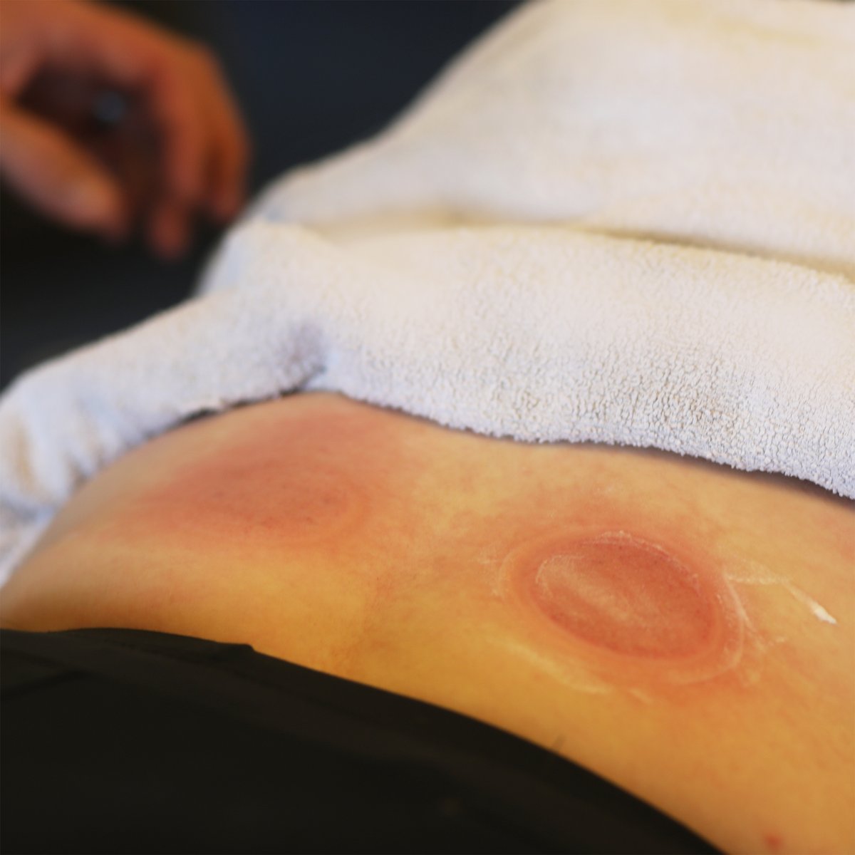 ProActiveAZ's tweet image. Who needs a muscle tune-up?🙋

Clinic Director &amp;amp; PT Travis Mason uses cupping therapy to draw the tissue upwards, increasing blood flow to the area. This helps to relieve muscle tension and pain, reduces inflammation, improves circulation, and many other benefits.