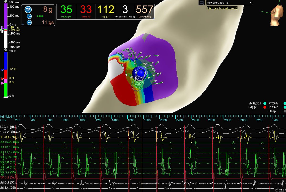 theRhythmDocs's tweet photo. Sometimes less is more. Finished the week with a WPW ablation in a hemodynamically unstable pt. Parked HD Grid near LL AP &amp; collected 5 tach beats before pace term. Clear trifurcated signals, lost AP conduction 3s into abl.

EP: Dr. Sameer Satija
Map: @_JeanStein @AlexJ_117_EP https://t.co/7Hoo8fJmKW
