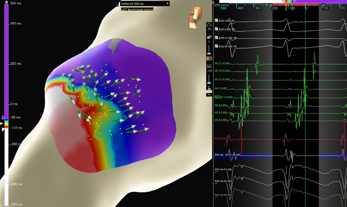 theRhythmDocs's tweet photo. Sometimes less is more. Finished the week with a WPW ablation in a hemodynamically unstable pt. Parked HD Grid near LL AP &amp; collected 5 tach beats before pace term. Clear trifurcated signals, lost AP conduction 3s into abl.

EP: Dr. Sameer Satija
Map: @_JeanStein @AlexJ_117_EP https://t.co/7Hoo8fJmKW