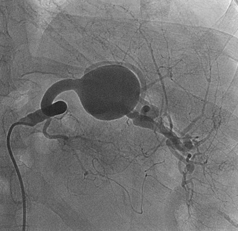 DocMahatma's tweet photo. Digital subtraction angiogram demonstrates a splenic artery aneurysm. Following interventional procedure: control angiogram show exclusion of aneurysm by the stent-graft.
#AbdRad #GIrad #irad #radiology #radtwitter #INCMNSZ #radiologia https://t.co/YXB2QBOjZu