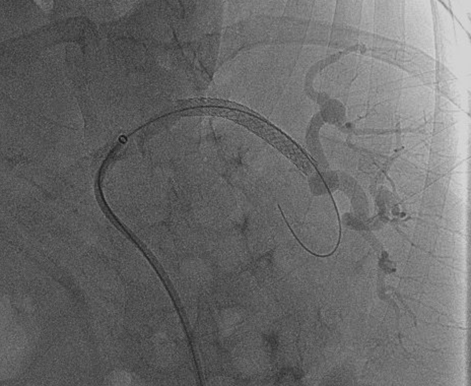 DocMahatma's tweet photo. Digital subtraction angiogram demonstrates a splenic artery aneurysm. Following interventional procedure: control angiogram show exclusion of aneurysm by the stent-graft.
#AbdRad #GIrad #irad #radiology #radtwitter #INCMNSZ #radiologia https://t.co/YXB2QBOjZu