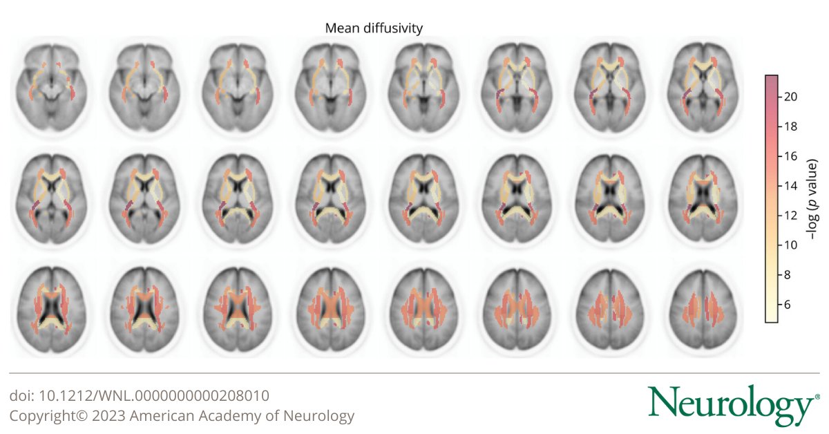 In this study, poor oral health was associated with worse neuroimaging #BrainHealth profiles. Genetic analyses confirmed these associations, supporting a potentially causal association. Read the article: bit.ly/3S6orgw

#NeuroTwitter