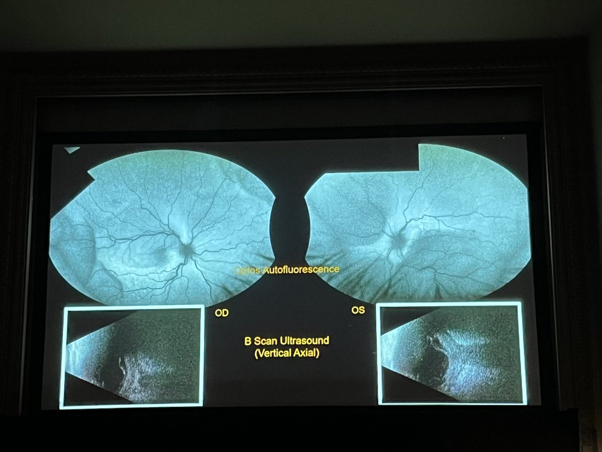 Tamara L. Lenis, MD, PhD, used a case of malignant melanoma treated with pembrolizumab to showcase the potential retinal side effects of immunotherapy. #ACRC2024 #Retina