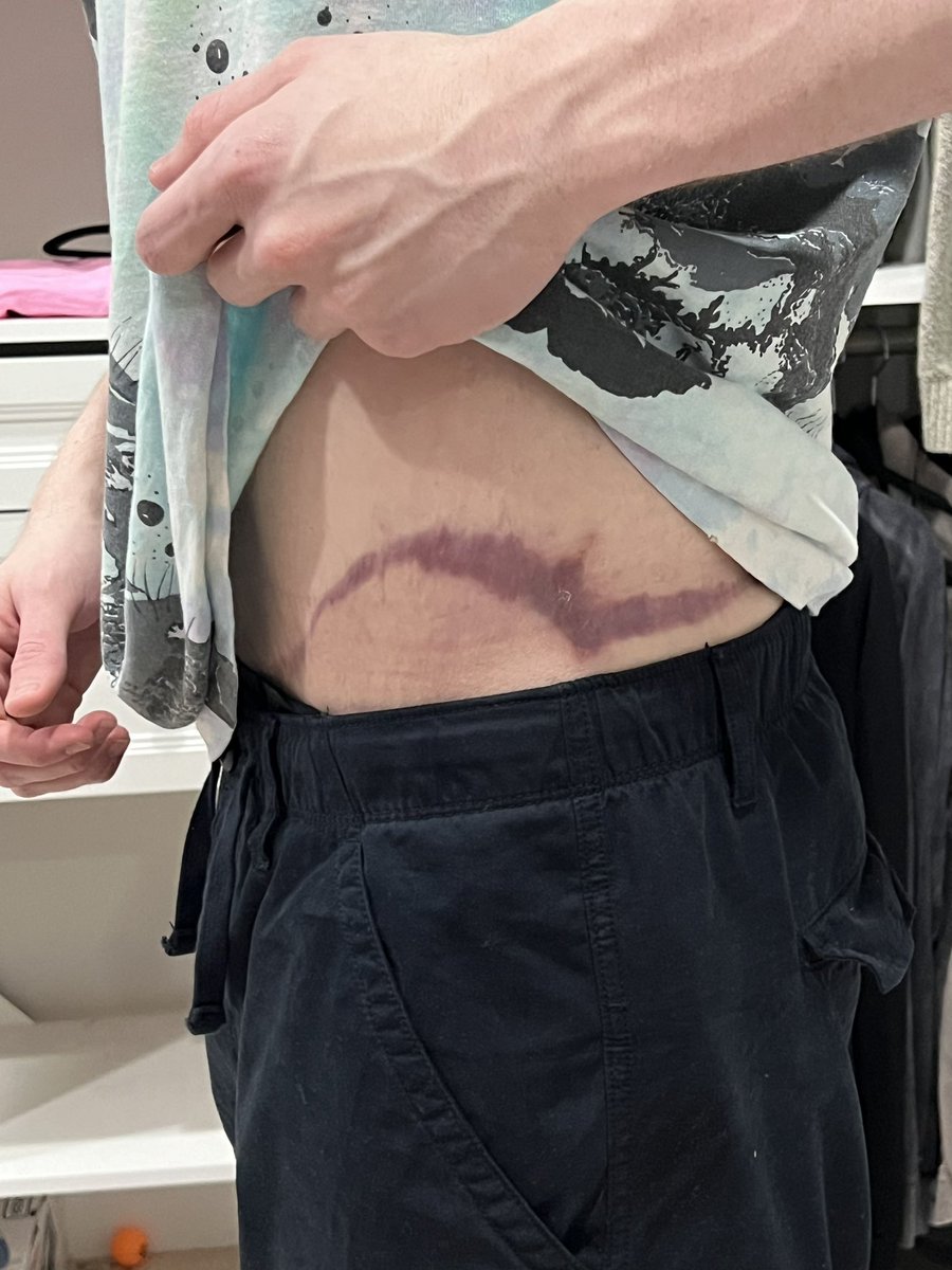 dreamwastaken's tweet image. This time 7 years ago I weighed over 500 pounds. 

Last year after finally being a stable weight for enough time, I had almost 15 pounds of loose skin removed.

and it all started with a New Years resolution.

hope you’re still sticking to yours this year. happy new year :)