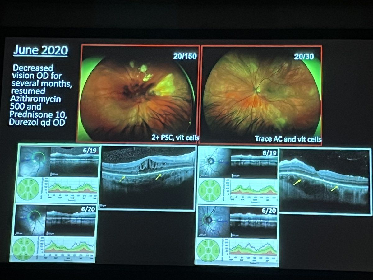 A patient presented with an episode of toxoplasma choroiditis…two years later he presented with similar findings, but this time repeat testing by Naomi Goldberg, MD, PhD, revealed it was syphilis. #ACRC2024 #Retina