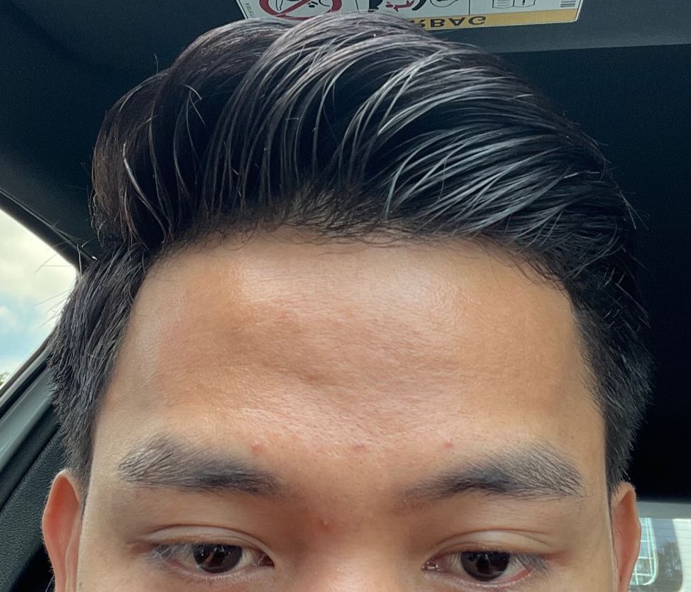 aaaaweng's tweet photo. For those yang kulit tengah breakout, jerawat susah nak surut and all, never give up &amp; keep on fighting.

Besides body building, skincare is also a journey 🫶🏻🩵 https://t.co/2MxDf7tmFI