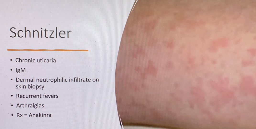 DavidACohen3's tweet photo. Clinical Pearl of the Day # 4 from Lankenau Virtual Grand Rounds with Papa Heme @AaronGoodman33 on Monoclonal Gammopathies: What is Schnitzler Syndrome ?  @acweyand @BrownJHM @connors_md @tamer_khashab @TTelvizian @AlishaMaity @KDaugherty22 @EricStarFox @COREIMpodcast https://t.co/9hLGYCZxX4