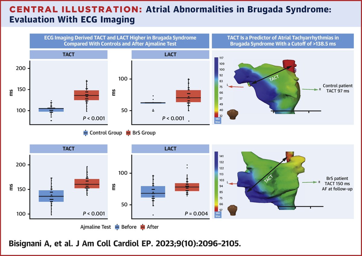 ECGI-calculated TACT & LACT are sig. prolonged in Brugada syndrome (BrS) patients compared w/ control patients, & in BrS patients after ajmaline. This may be consistent w/ a concealed atrial #cardiomyopathy in BrS. bit.ly/3MzVzKy

#JACCCEP #EPeeps #ECG @AntBisignani_MD