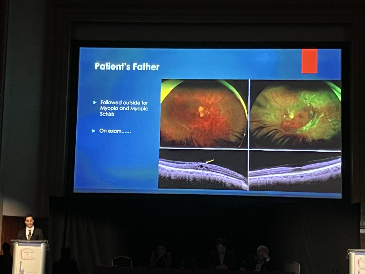 Double circumferential rings of traction in a whole family with myopia helped Nimesh A. Patel, MD, diagnose Wagner syndrome. #ACRC2024 #Retina