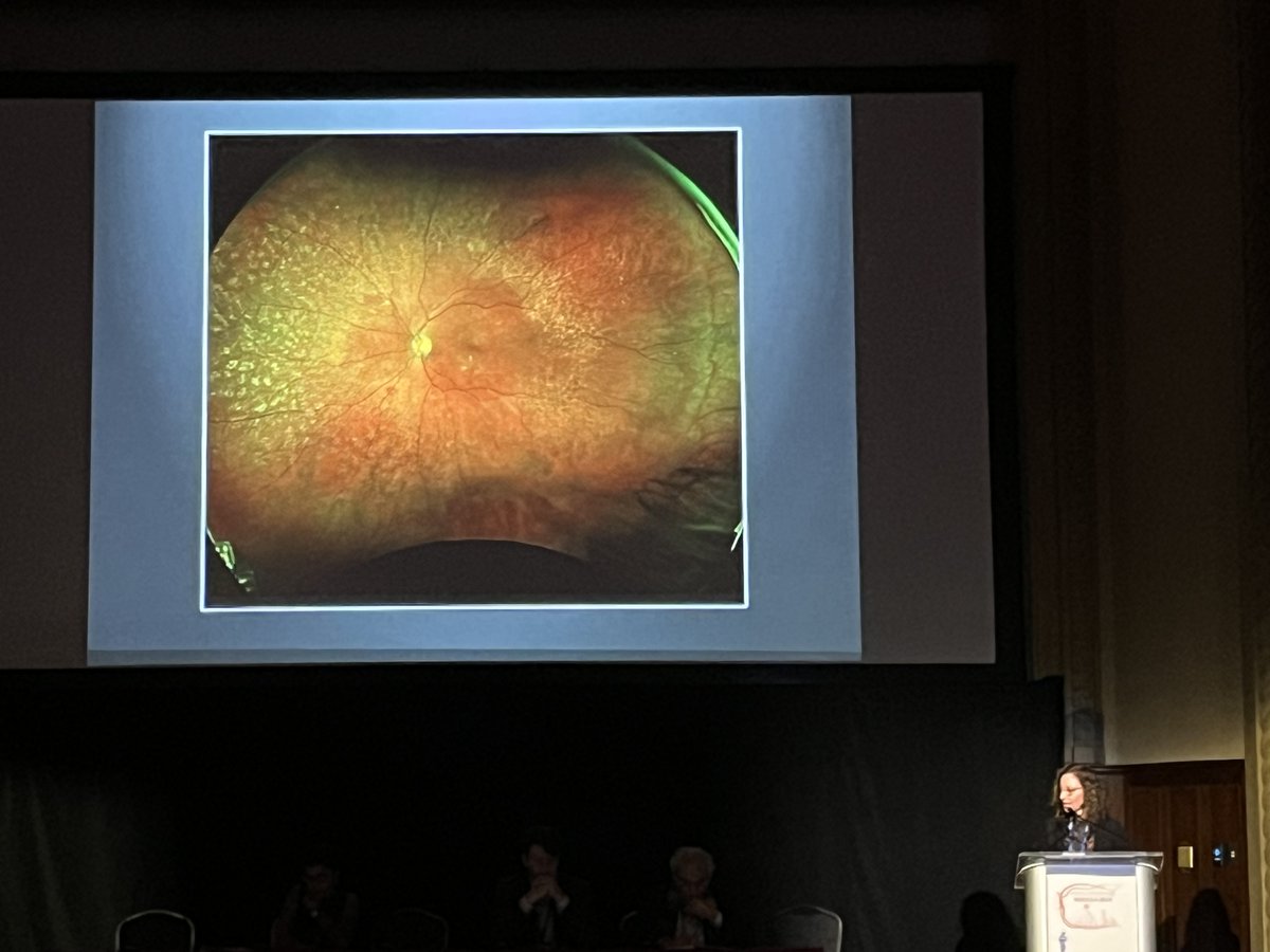Jaclyn L. Kovach, MD, wrapped up the second day of #ACRC2024 with a case of sorsby fundus dystrophy masquerading as AMD. #Retina